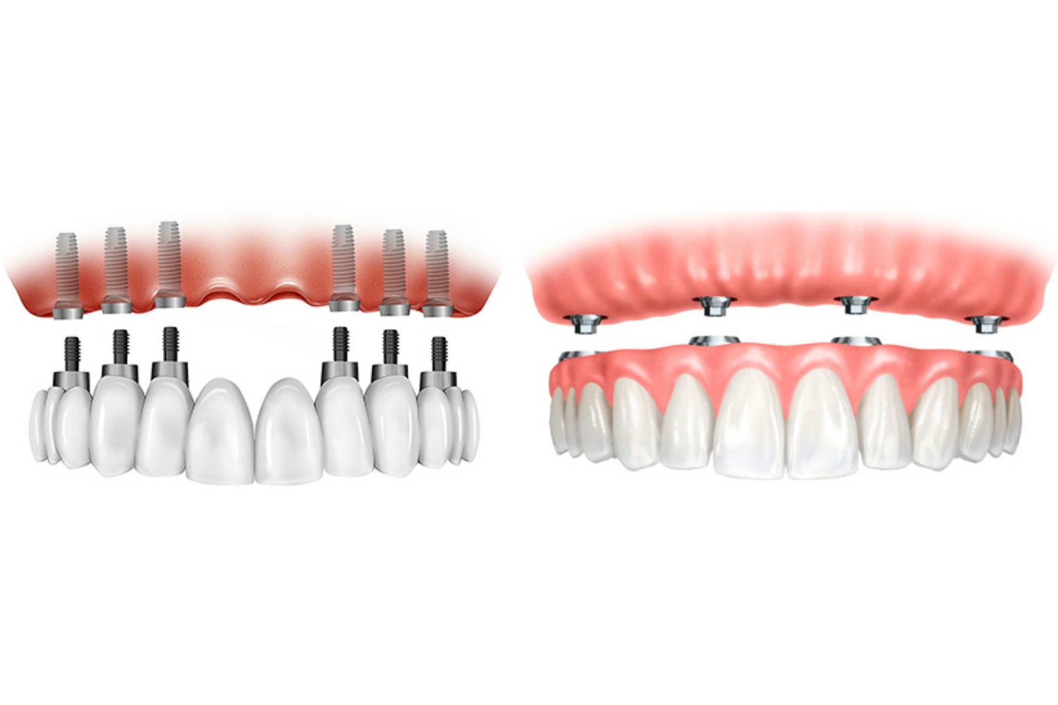 Especialistas Implantes Dentales en Arroyomolinos
